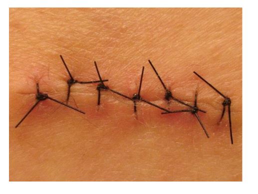 Los puntos de sutura: ¿son los que realmente te curan? Foto de puntos de sutura en la piel