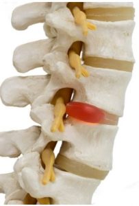Subluxaciones en la columna vertebral. Modelo de una columna con vértebras, cartílagos y nervios